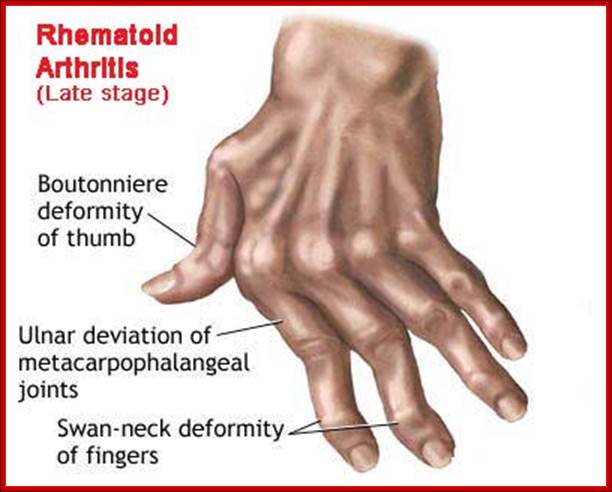 Gene therapy for rheumatoid arthritis