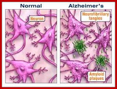 Image result for alzheimer plaques in patients