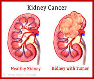 Image result for kidney tumour