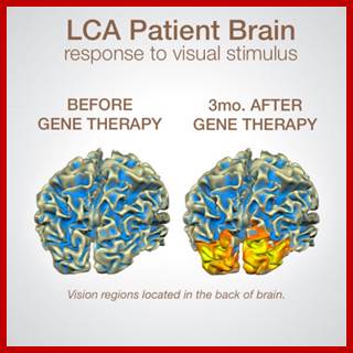 Hereditary Blindness