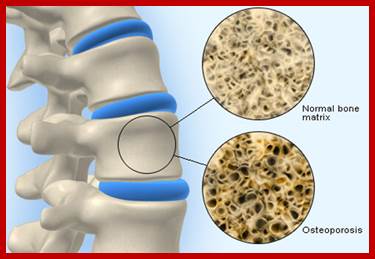 Illustration shows normal bone density and weakened bone affected by osteoporosis.