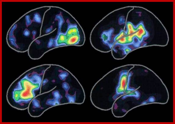 PET Brain Scans