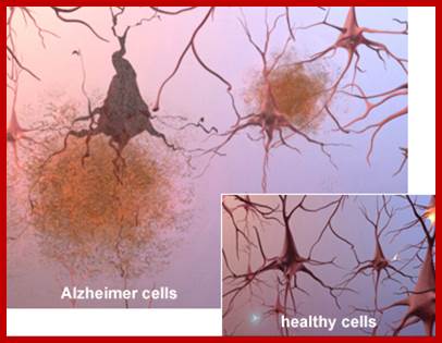 Microscopic Illustration of Alzheimer's tissue with plaques and tangles