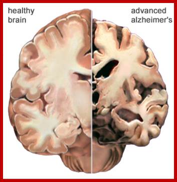 Cross section of healthy and Azlheimer's brain